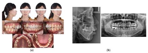 牙齒丟屋頂|牙齒掉了丟屋頂？ – 黃郁芩醫師 Orthodontics